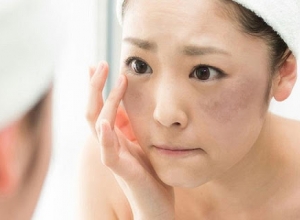 Top những cách trị nám da mặt lâu năm hiệu quả mà chị em không nên bỏ qua 